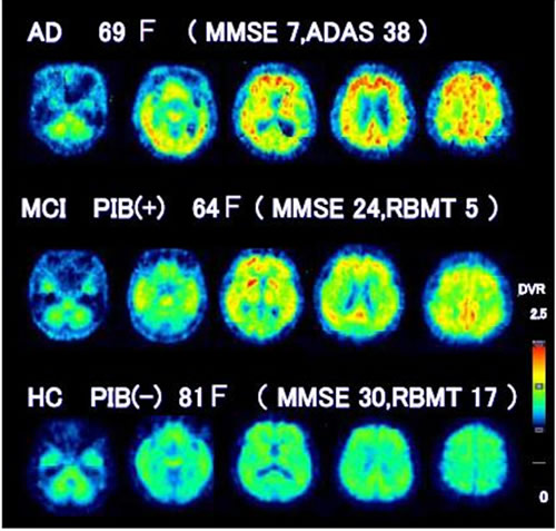 図１　PIB-PET画像